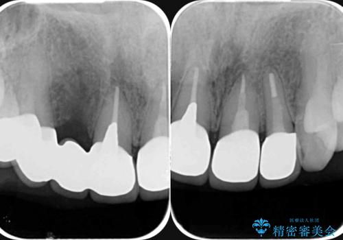 境目の見える前歯をきれいにしたい セラミック治療の治療後