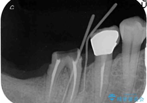 奥歯から膿のにおいがする インプラントによる機能回復の治療前