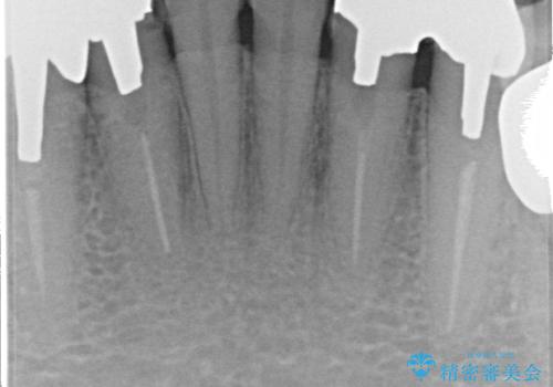 [ セラミック治療 ] 前歯の見た目を改善したいの治療前