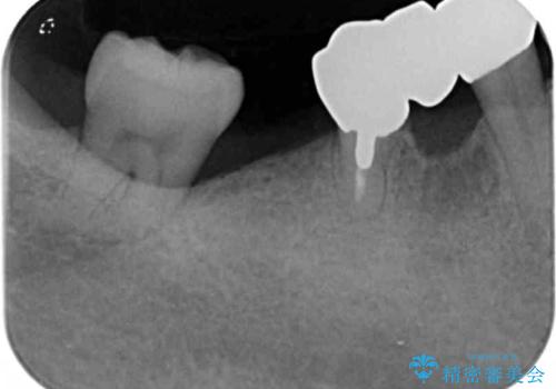 長期的な予後を見据えたインプラント治療の治療前