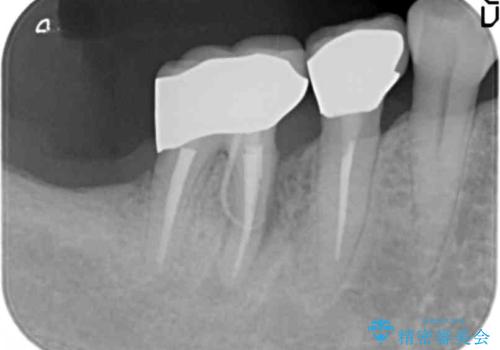 奥歯から膿のにおいがする インプラントによる機能回復の治療前