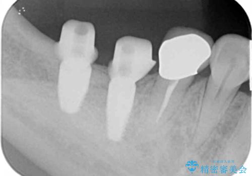 奥歯から膿のにおいがする インプラントによる機能回復の治療中