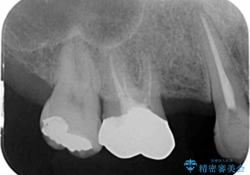 長期的な予後を見据えたインプラント治療の治療前