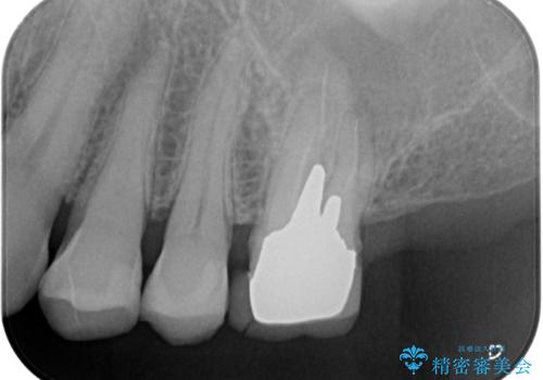 欠損した奥歯 インプラントによる補綴治療の治療前