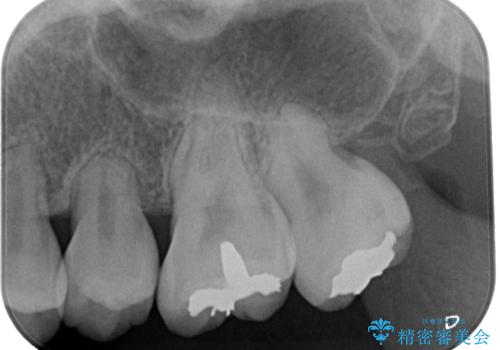 矯正治療で移動を終えた歯 オールセラミッククラウンでのむし歯治療の治療前