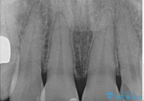 変色を綺麗にしたい 前歯と奥歯のオールセラミッククラウン治療の治療前