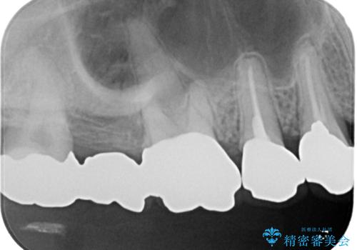 変色を綺麗にしたい 前歯と奥歯のオールセラミッククラウン治療の治療前