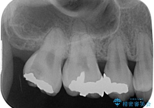 矯正治療で移動を終えた歯　オールセラミッククラウンでのむし歯治療の治療前