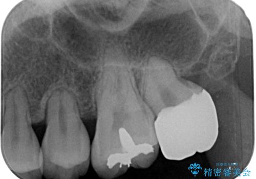 矯正治療で移動を終えた歯　オールセラミッククラウンでのむし歯治療の治療後