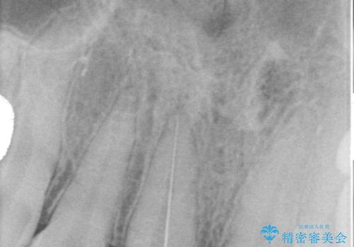 変色を綺麗にしたい 前歯と奥歯のオールセラミッククラウン治療の治療中