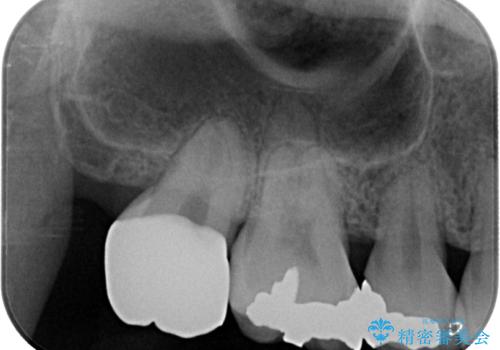 矯正治療で移動を終えた歯　オールセラミッククラウンでのむし歯治療の治療後