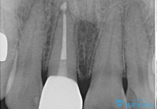 変色を綺麗にしたい 前歯と奥歯のオールセラミッククラウン治療の治療後