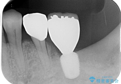 ブリッジから膿が出る 奥歯のインプラント治療の治療後