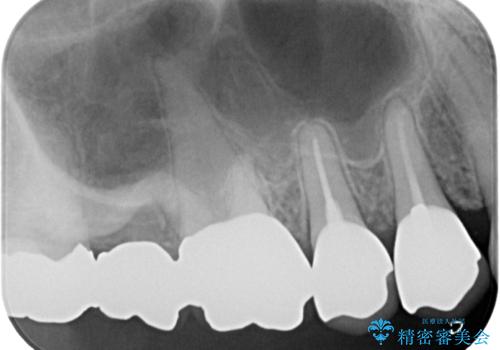 変色を綺麗にしたい 前歯と奥歯のオールセラミッククラウン治療の治療後