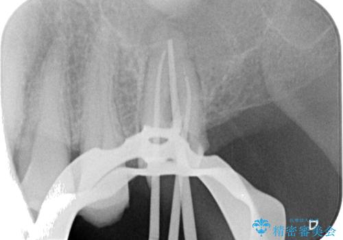 欠損した奥歯 インプラントによる補綴治療の治療中