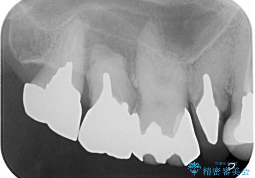 米粒のような小さい歯 セラミッククラウンでバランスを改善の治療前