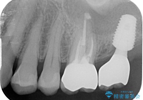 欠損した奥歯 インプラントによる補綴治療の治療後