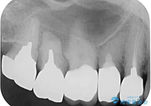 米粒のような小さい歯 セラミッククラウンでバランスを改善の治療後