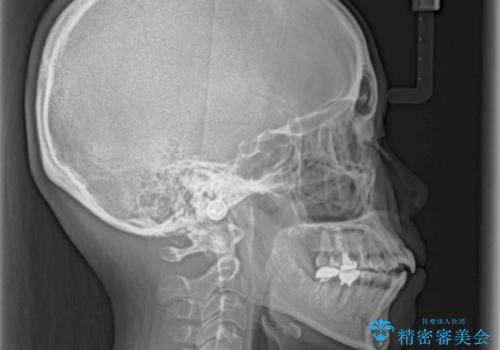 急速拡大装置　狭い骨幅を拡大した上で、顕著なデコボコを改善する抜歯矯正治療の治療前