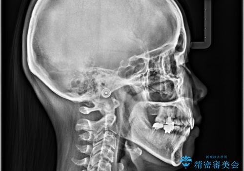 急速拡大装置 狭い骨幅を拡大した上で、顕著なデコボコを改善する抜歯矯正治療の治療後