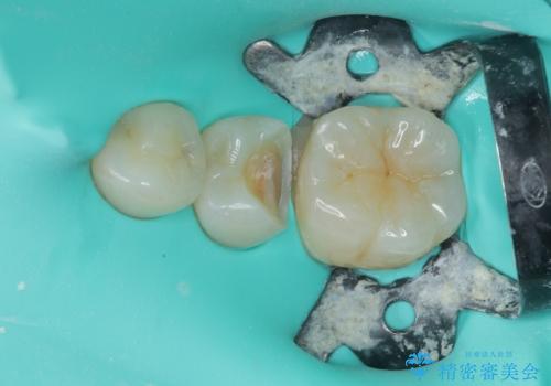 左下に虫歯が見つかった セラミックインレー修復の治療中