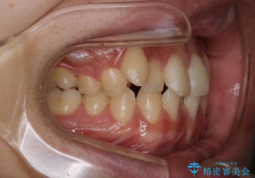 【クリア装置】八重歯とがたつきを綺麗にの治療前