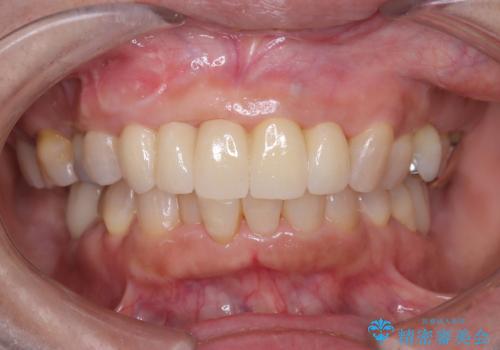 歯茎の腫れが気になる方必見!|抜歯即時インプラントで前歯5本を痛みなく3か月で治療完了!の症例 治療後