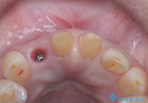 前歯の隙間とへこみが舌で触ると気になる|矯正治療は絶対にしたくない|抜歯即時インプラント+オールセラミッククラウンで審美修復の治療中