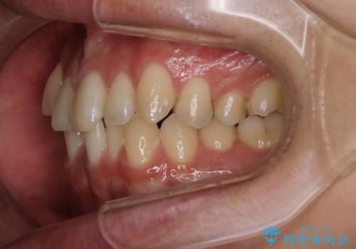 【クリア装置】八重歯とがたつきを綺麗にの治療前