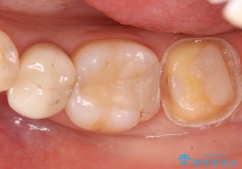 奥歯に虫歯があると言われた セラミッククラウンでキレイで長持ちする歯への治療中