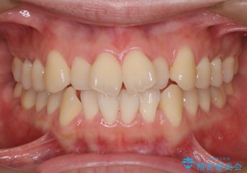 【審美装置】前歯のデコボコを綺麗に