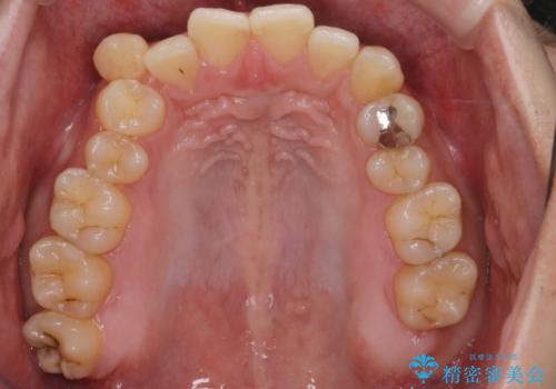【クリア装置】八重歯とがたつきを綺麗にの治療前