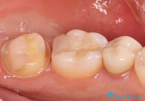 奥歯に虫歯があると言われた セラミッククラウンでキレイで長持ちする歯への治療中