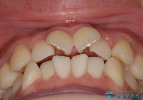 【審美装置】前歯のデコボコを綺麗にの治療前