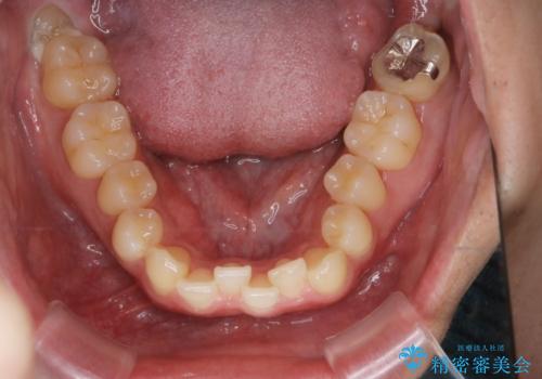 【クリア装置】八重歯とがたつきを綺麗にの治療前