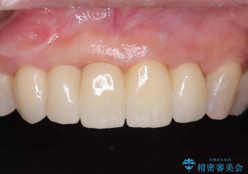 歯茎の腫れが気になる方必見!|抜歯即時インプラントで前歯5本を痛みなく3か月で治療完了!の治療後