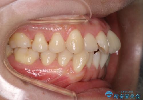 【審美装置】前歯のデコボコを綺麗にの治療前