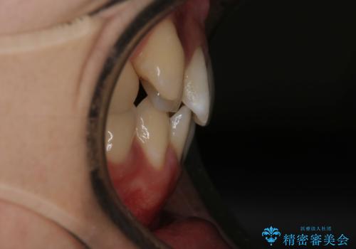 【クリア装置】八重歯とがたつきを綺麗にの治療前