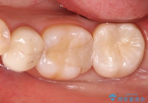 奥歯に虫歯があると言われた セラミッククラウンでキレイで長持ちする歯への治療後
