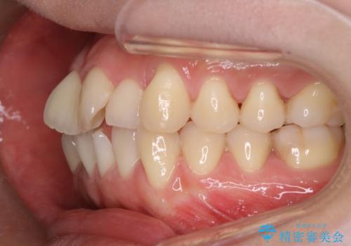 【審美装置】前歯のデコボコを綺麗にの治療前