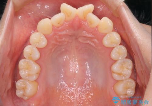 【審美装置】前歯のデコボコを綺麗にの治療前