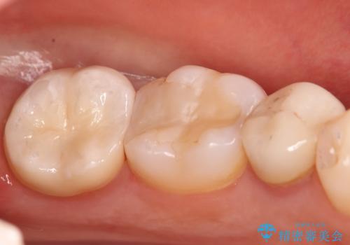 奥歯に虫歯があると言われた セラミッククラウンでキレイで長持ちする歯への症例 治療後