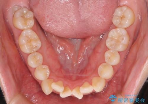 【審美装置】前歯のデコボコを綺麗にの治療前