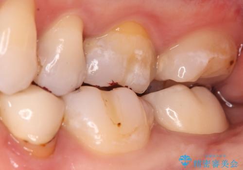 奥歯に虫歯があると言われた　セラミッククラウンでキレイで長持ちする歯への治療後