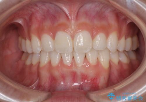 斜め前に飛び出した前歯 抜歯矯正で素敵な横顔にの治療後