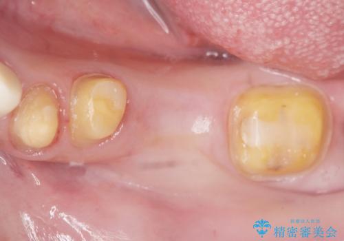 銀歯のブリッジをジルコニアブリッジへの治療中