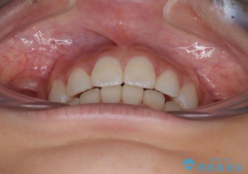 斜め前に飛び出した前歯 抜歯矯正で素敵な横顔にの治療後