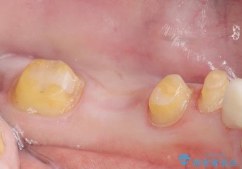 銀歯のブリッジをジルコニアブリッジへの治療中