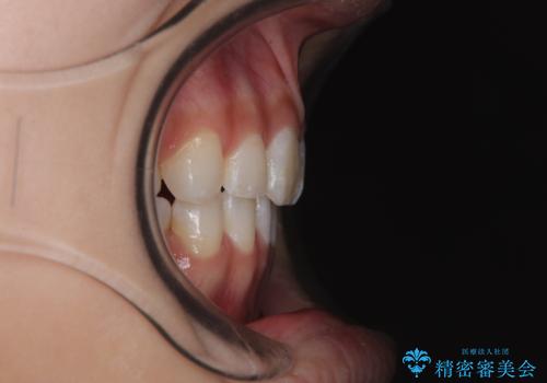 斜め前に飛び出した前歯 抜歯矯正で素敵な横顔にの症例 治療後