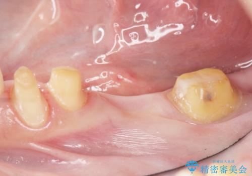 銀歯のブリッジをジルコニアブリッジへの治療中